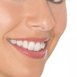 Ortodonti, Yetişkinlerde Ortodonti Tedavisi