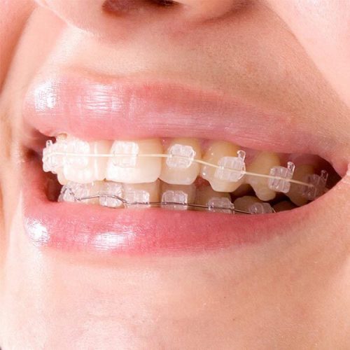 Ortodonti, Yetişkin Ortodontisi: Tedavi Çeşitleri ve Planlaması