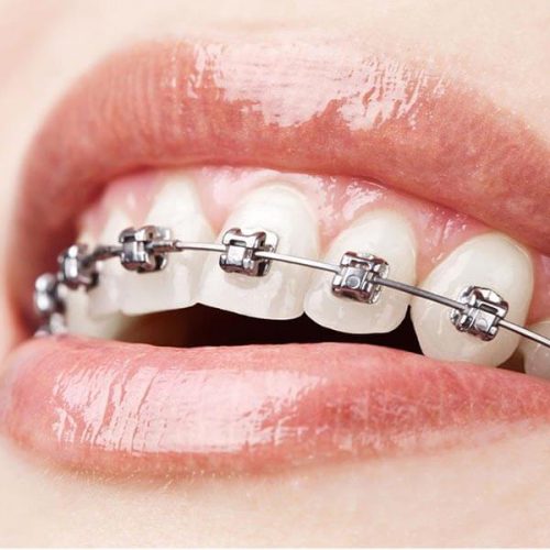 Ortodonti, Yetişkin Ortodontisi: Tedavi Çeşitleri ve Planlaması
