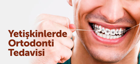 , Ortodonti Tedavisi &#8211; Sıkça Sorulan Sorular
