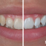 Sararan dişlerin farklı yöntemlerle nasıl beyazlatılabileceği hakkında detaylı bilgi.
