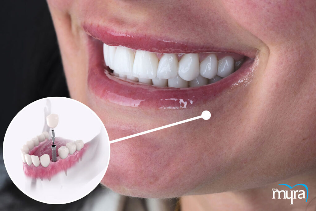 implant tedavisi, Antalya Diş İmplant Tedavisi