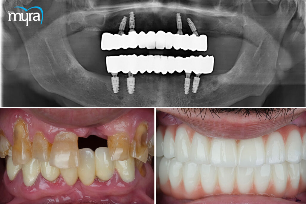 implant tedavisi, Antalya Diş İmplant Tedavisi