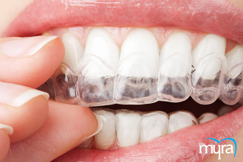 Diş beyazlatma, Antalya Diş Beyazlatma Tedavisi