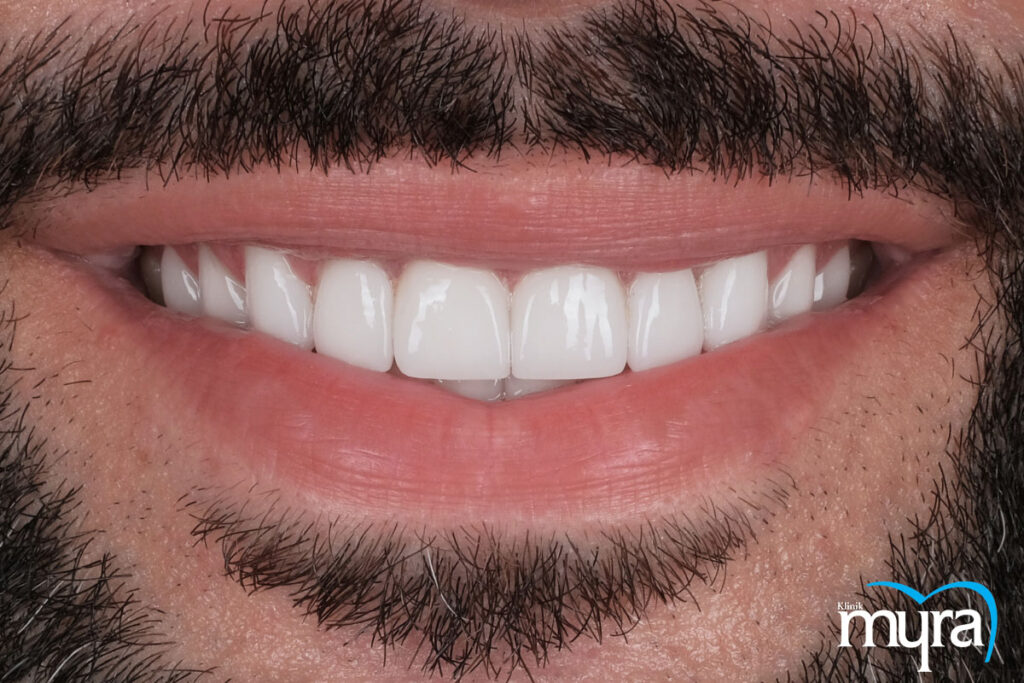 Diş beyazlatma, Antalya Diş Beyazlatma Tedavisi