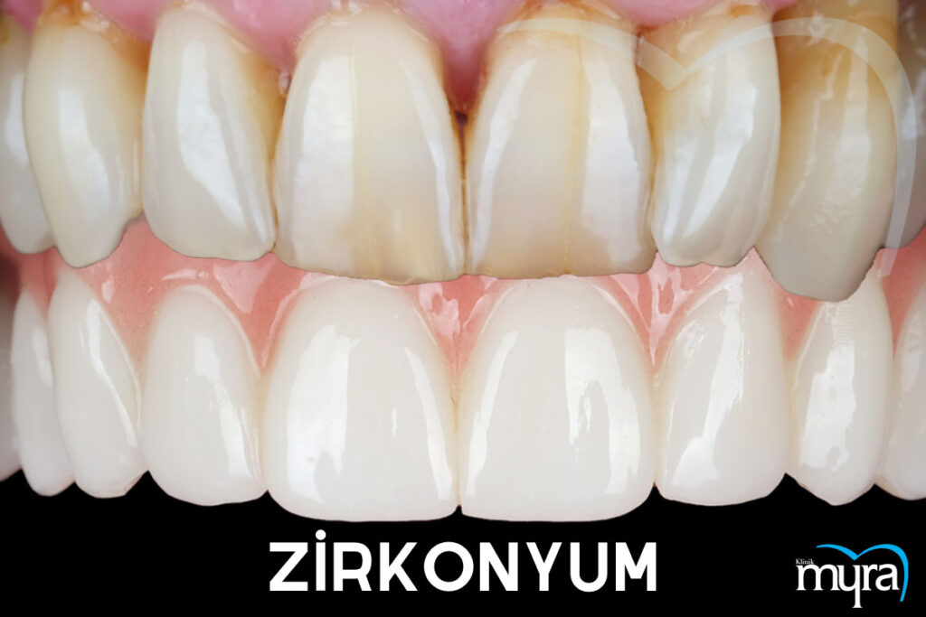 Zirkonyum Diş Kaplama Tedavisi Öncesi ve Sonrasında Dişlerin Estetik ve Fonksiyonel Görünümü.